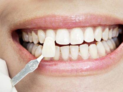 L'enregistrement des mesures et le choix des dents