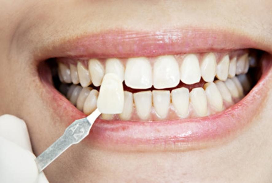 L'enregistrement des mesures et le choix des dents